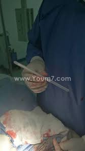 بالصور رجل يلجأ لتركيب جهاز تعويضى بالعضو الذكرى لمساعدته على الزواج والإنجاب المريض أجرى العملية منذ 3سنوات بقصر العينى وفشلت والطبيب جهاز أرجنتينى بـ6 آلاف جنيه يساعد على الانتصاب بضمان 15 سنة
