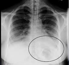 Left untreated, pneumonia may have an overall mortality rate of more than 30%. Condition Specific Radiology Pneumonia Stepwards