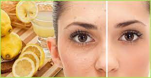 12 Home Remedies For Freckles On Face And Prevention Tips