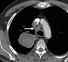 Lung cancer typically doesn't cause signs and symptoms in its earliest stages. Small Cell Lung Carcinoma Staging Imaging And Treatment Considerations Radiographics