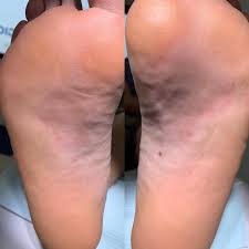 Image result for Tinnea vesiculosa