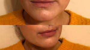 61 Revive Light Therapy Testimonies Ideas Light Therapy Therapy Testimony