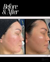 Incredible results achieved with our Bright & Tone Laser Peel treatment⚡️!  This advanced laser rejuvenating treatment combines 3 techniques using our  Lutronic Clarity platform: ・Alex Toning