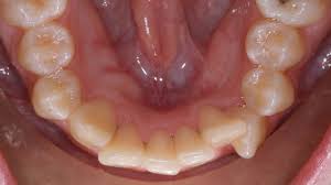 Is there a good or bad age to get your wisdom teeth removed? Do I Need To Remove My Wisdom Teeth Phan Family Dentistry