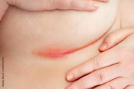 Image result for Intertrigo under breasts