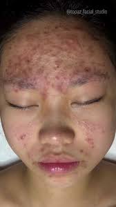 Dmk Muscle Banding Therapy