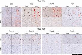 Aug 13, 2012 · these men include (broadly): Frontotemporal Lobar Degeneration Proteinopathies Have Disparate Microscopic Patterns Of White And Grey Matter Pathology Acta Neuropathologica Communications Full Text