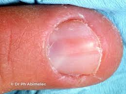 Image result for Glomus tumor