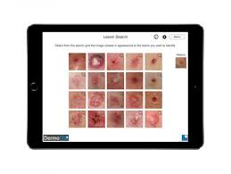 Arising from melanocytes, melanoma can look like a mole and some develop within an existing mole. App Trains Healthcare Professionals To Detect Early Stage Skin Cancer