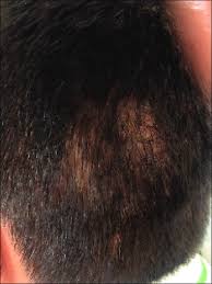 The white speck ringlet (erebia claudina) is a member of the subfamily satyrinae of family nymphalidae. Patchy Hair Loss With Minimal Scaling In A 10 Year Old Boy Download Scientific Diagram