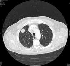 Lung cancer is one of the most common and serious types of cancer. Low Dose Ct Scans Show Promise In Detecting Early Stage Lung Cancer Highmark Health Blog