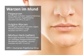 Sie kann menschen jeden alters befallen, häufig jedoch kinder, da deren immunsystem noch nicht. Wie Lassen Sich Schleimhautwarzen Im Mund Entfernen