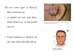 It is associated with a poorer prognosis than bells palsy and sequelae such as persistent synkinesis and hearing loss, are more common 22. Pin On Ramsay Hunt Syndrome
