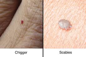 Image result for scabies human bites