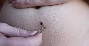 This video shows the removal of an ingrown hair that's masquerading as a blackhead. The Longest Ingrown Hair You Ll Ever See Wtf Video