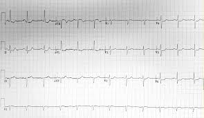 Image result for ST Elevation