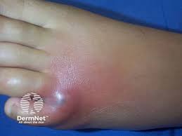 Image result for yellow sac spider bite skin