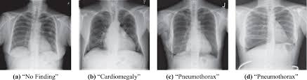If you cannot diagnose a tension pneumothorax at medical finals you won't find an examiner who will defend you. Comparison Of Deep Learning Approaches For Multi Label Chest X Ray Classification Scientific Reports