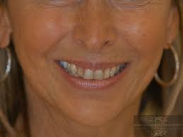 Cosmetic Dentistry: Transform Your Smile Today