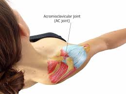 How long can a dislocated shoulder take to heal? answered by dr. Ac Joint Seperations And Injuries A Patients Guide