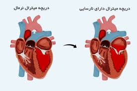 علائم و عوارض نارسایی دریچه میترال چیست؟ | کلینیک قلب سلامت