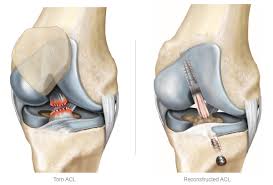 Knee Sports Injury Anterior Cruciate Ligament Acl
