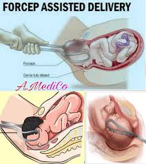 Image result for Forceps Assisted Delivery