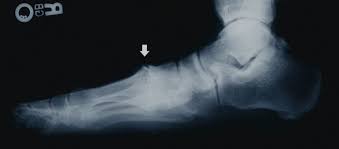 My xrays showed arthritis and bone spurs i don't have irritation on top of the toe. Bone Spur Back Of Head