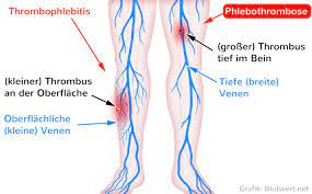 Risiko Phlebothrombose Tiefe Bein Venenthrombose Tvt