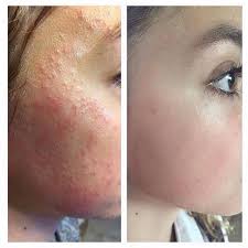 This Is 11 Year Old Karis She Had An Allergic Reaction And This Was The Result Her Mom Took Her To A Dermatologist Immediately And Got A Prescription For Her