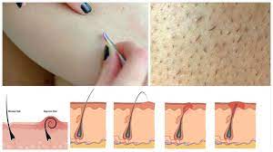 Since the most common cause of ingrown hairs is cutting or removal of the hair below the level of the follicular orifice (commonly called a pore by patients), it typically tends to occur on your face, neck, armpits, groin, and legs. Get Rid Of Ingrown Hairs Vedics