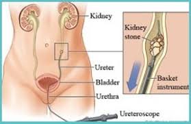 Laser Treatment For Kidney Stone In Pune Kidney Stone Treatment In Pune