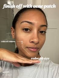 19 top How to Get Rid of A Pimple Awith No Head ideas in 2024