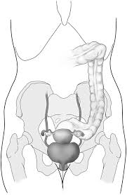 From renal pelvis to the pelvic brim courses along the anterior & medial aspect of the psoas muscle until it crosses over 22. Gynecologic Laparoscopy Surgical Clinics