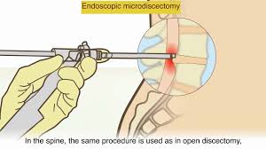 A Herniated Disc What Is It And What Surgical Treatments Are Available Youtube