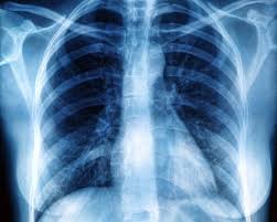 Image result for Chest XRay
