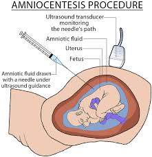 A leaking amniotic fluid is a common problem experienced by pregnant women. Amniotic Fluid Excess Low And Leaking Amniotic Fluid
