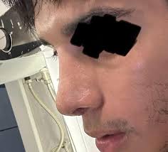 Amazing Difference After An 11k Nose Job …..🤣🤣🤣