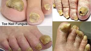 cure toenail fungus with vicks vaporub