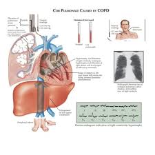 Image result for Cor Pulmonale