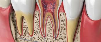 Die ursachen für eine notwendige wurzelbehandlung sind vielfältig. Endodontie Oder Wurzelbehandlung In Berlin Dr Droseler Praxis Fur Oralchirurgie Und Implantologie