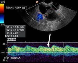 Ultrasound uterine and ovarian vascularity. Early Diagnosis Of Ovarian Carcinoma Is A Solution In Sight Radiology