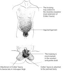 We found 4 dictionaries with english definitions that include the word bucks fascia: 22 Butterfly Bruising Following Rupture Of Buck S Fascia Download Scientific Diagram