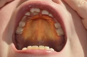 Image result for oral thrush symptoms roof of the mouth