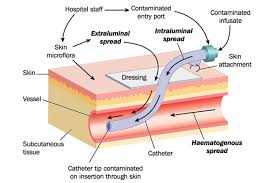Image result for Peripheral IV Access