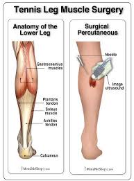 Surgery For Tennis Leg Gastrocnemius Muscle Leg Muscles Soft Tissue Injury