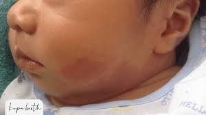 Image result for Nevus Simplex