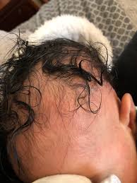 Up to 60% of your hair that is in the growth state may enter into the telogen resting state. Baby S Hair Falling Out August 2018 Babies Forums What To Expect