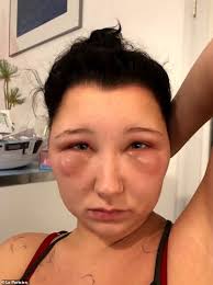 Woman's allergic reaction to hair dye causes severe swelling in face, head. Woman S Head Puffs Up After Allergic Reaction To Hair Dye And Becomes Virtually Unrecognisable Daily Vanity