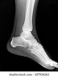 Image result for Foot XRay